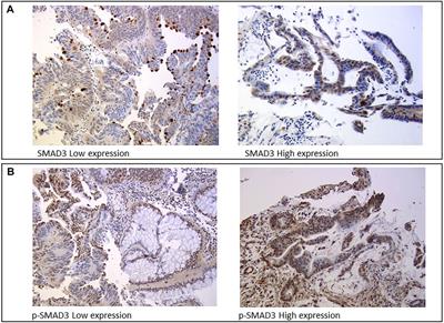 SMAD3 Host and Tumor Profiling to Identify Locally Advanced Rectal Cancer Patients at High Risk of Poor Response to Neoadjuvant Chemoradiotherapy